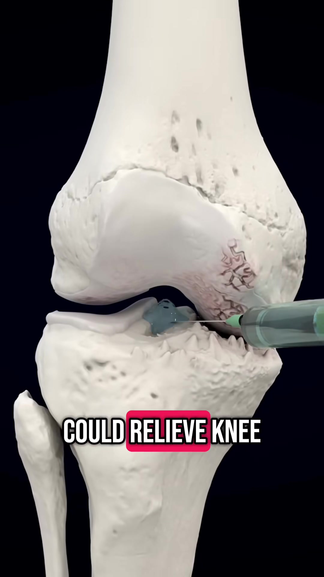 Visco Gel Injection For Treatment of Knee Osteoarthritis (3D Animatio...